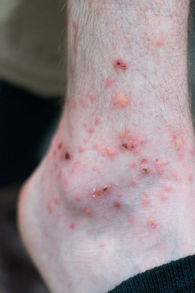 Datei:Entzündete Gelsenstiche.jpg