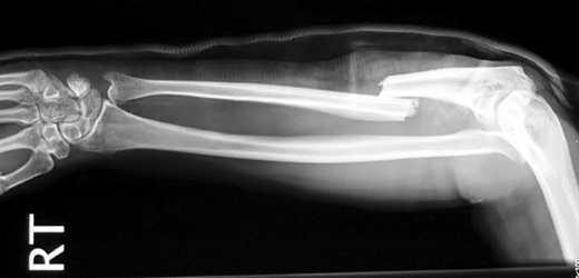 Datei:Gebrochene Speiche.jpg