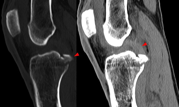 Datei:Röntgenbild Kreuzbandriss.jpg