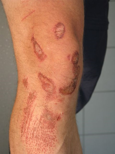 Datei:Schürfwunde am Bein.jpg