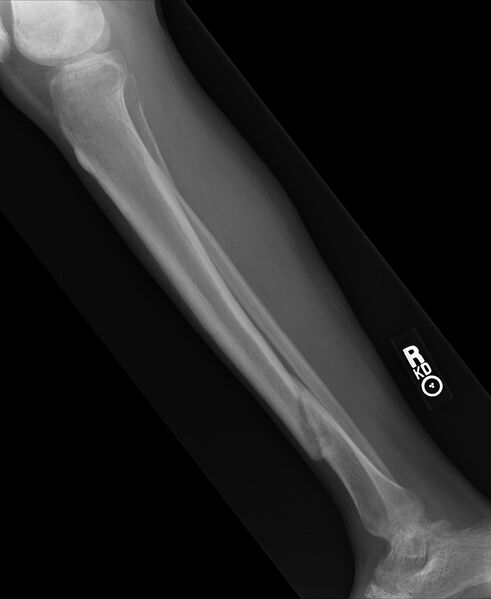 Datei:Gebrochenes Schienbein.jpg